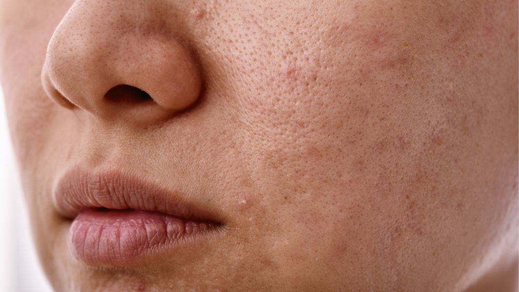 skin problem due to sugar intake