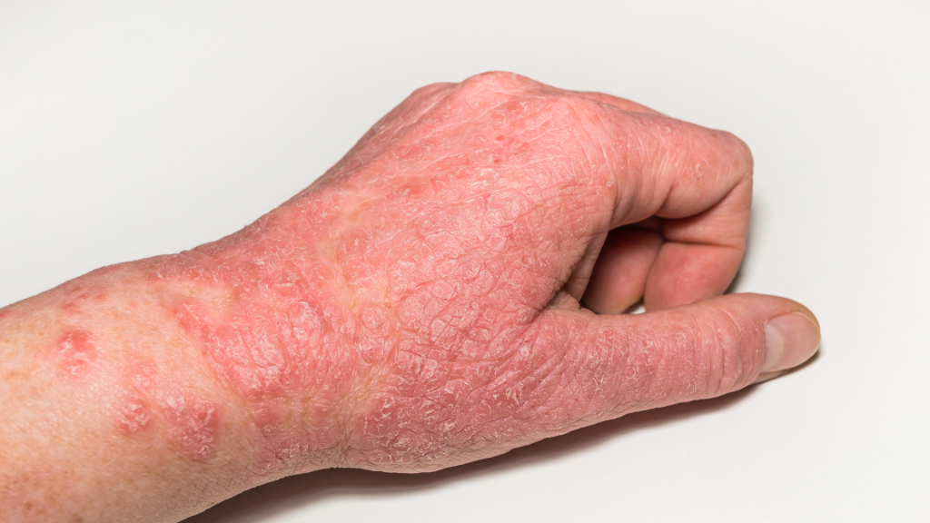 skin problem due to sugar intake