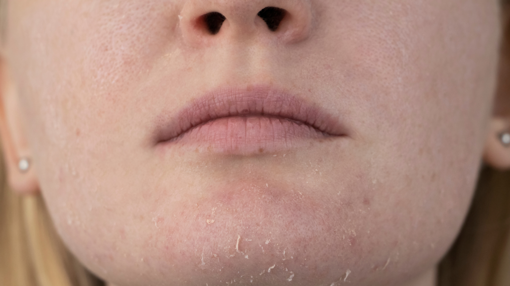 skin damage because of sugar
