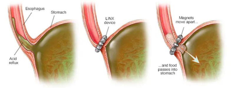 Substitute for esophageal sphincter