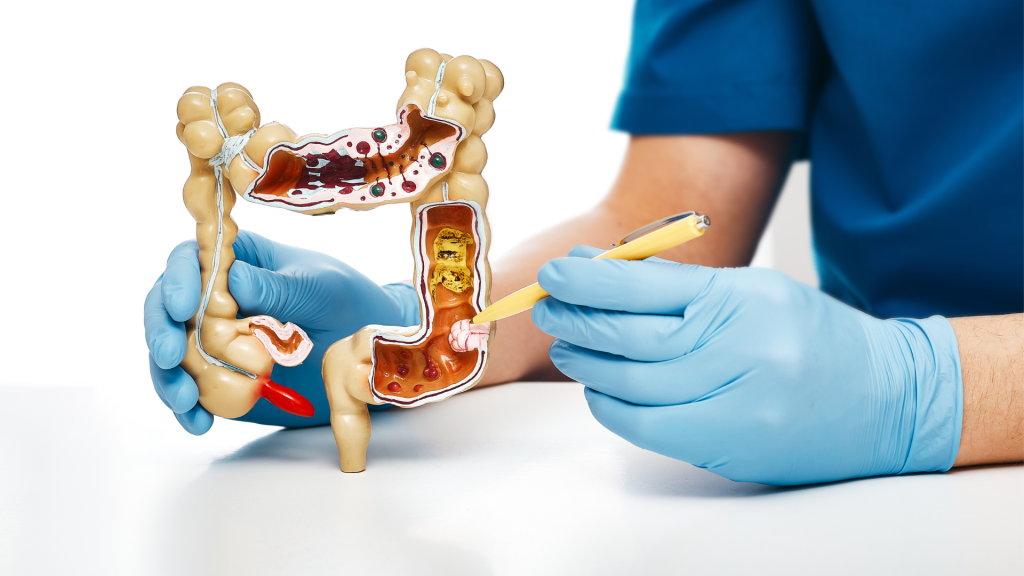 understanding what colon cancer