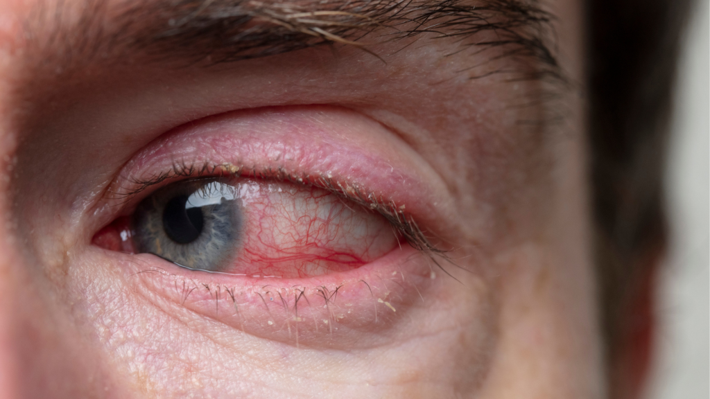 conjunctivitis during monsoon
