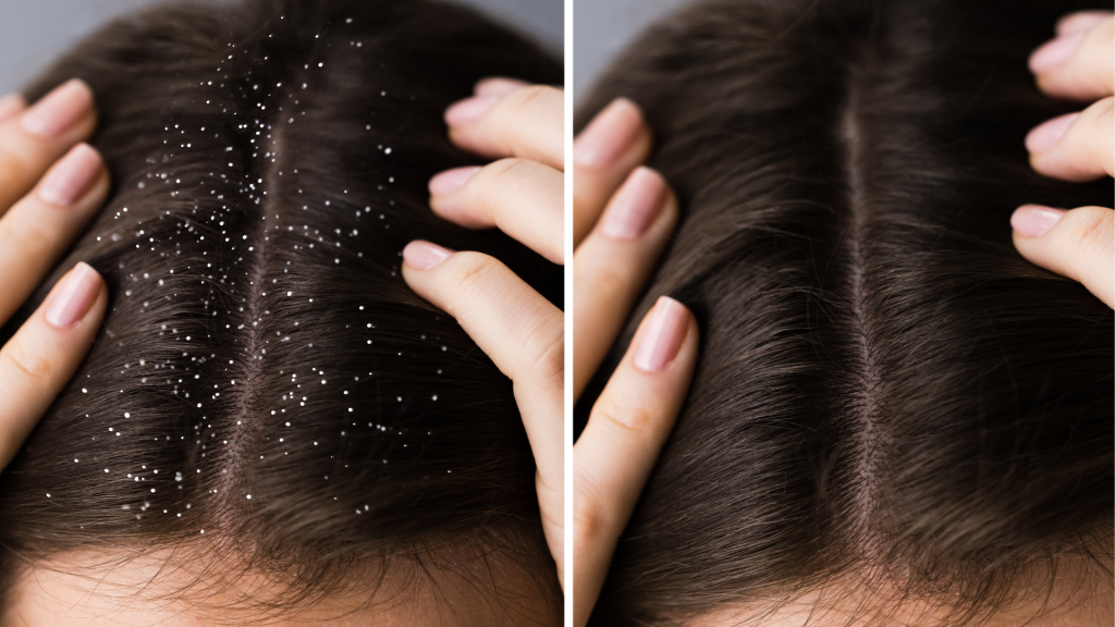 apply curd for dandruff