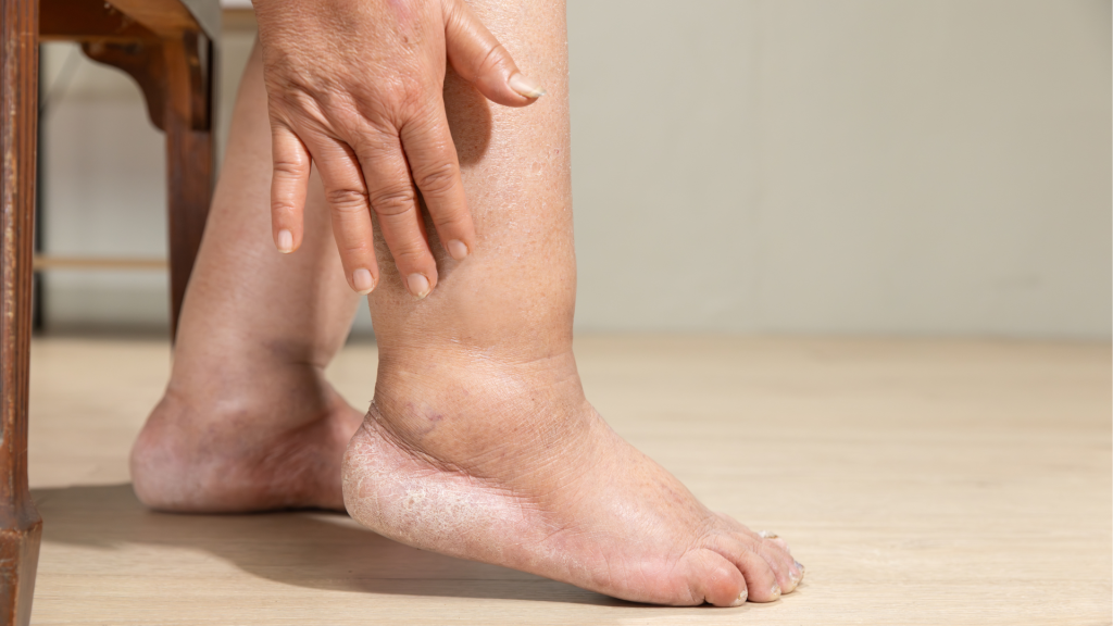 Swelling in Feet, Ankles, or Hands